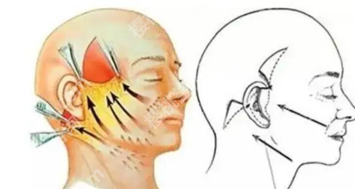 筋膜悬吊术适合多大年龄的？大概需要多少钱？有什么作用吗？