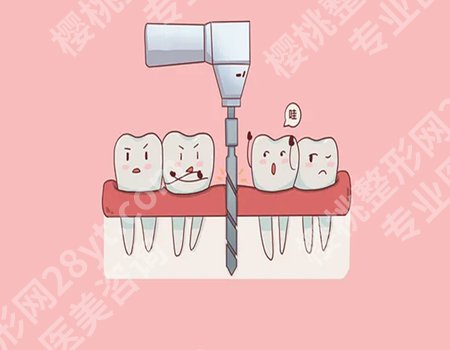 种植牙和烤瓷牙有什么区别？术后效果、操作方式以及适用人群方面有很大区别！