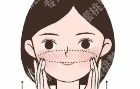 面部筋膜提升术能保持多久？效果好不好？术后恢复期是多久？