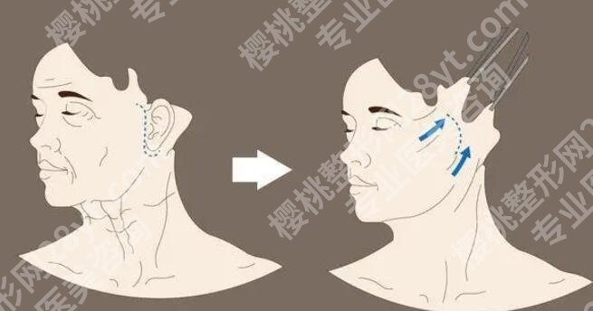 小拉皮手术好处和坏处你都知道吗?还不赶紧戳进来看!