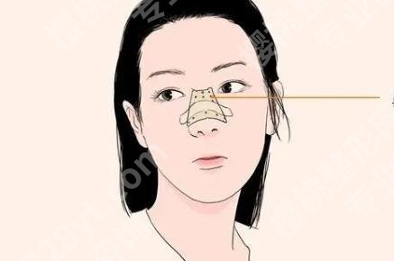 上海千美医院黄烈文怎么样?真人做隆鼻手术案例图曝光!