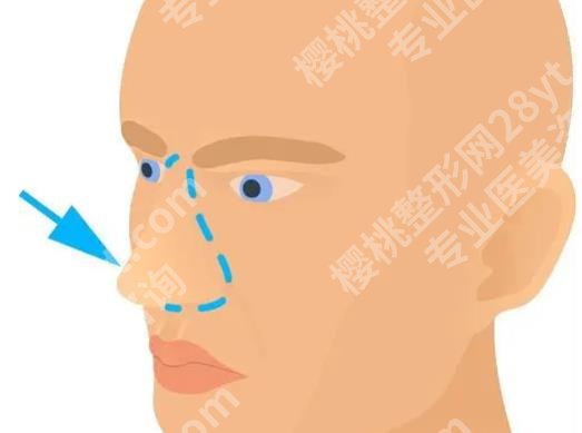 上海娜慕医疗美容医院隆鼻怎么样？隆鼻术后45天真实效果反馈！