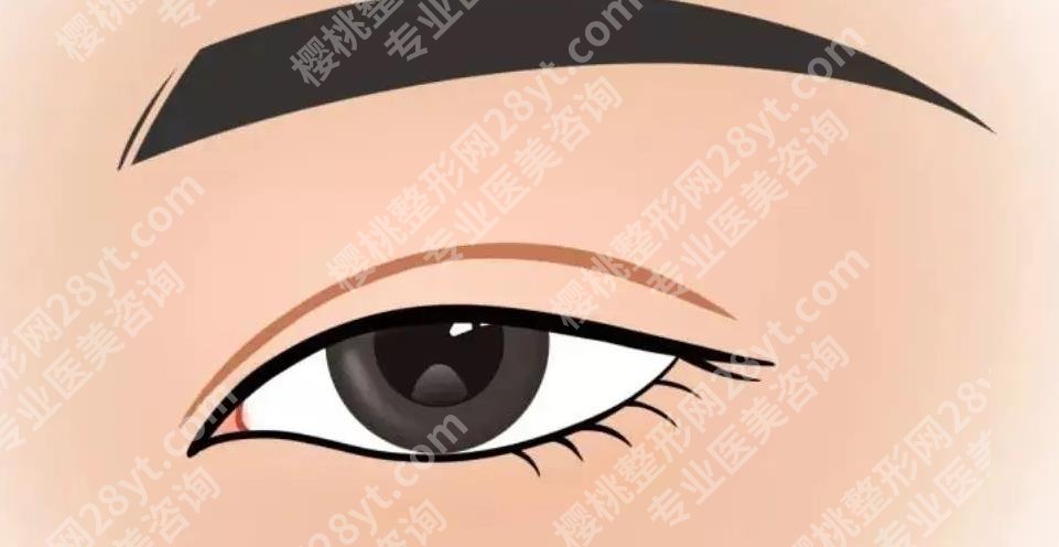 上海郑银龙整形医生做修复双眼皮怎么样?真人做眼部修复手术案例图