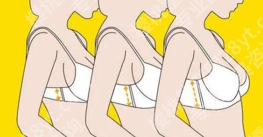 自体隆胸可以保持几年？术后多久可以恢复好？费用如何