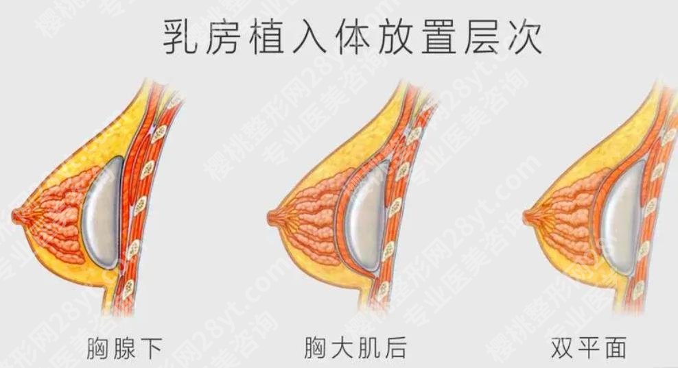 自体隆胸可以保持几年？术后多久可以恢复好？费用如何
