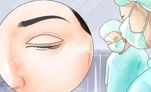 肿眼泡抽脂多少钱？抽脂手术可以反复做吗？来看价格表