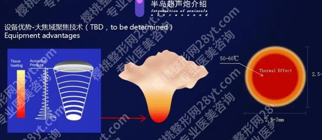 超声炮三天后脸变方了是怎么回事？做一次效果可以维持多久？