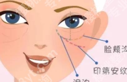 泪沟填充后淤青要多久才能恢复？填充要花多少钱？价格如何