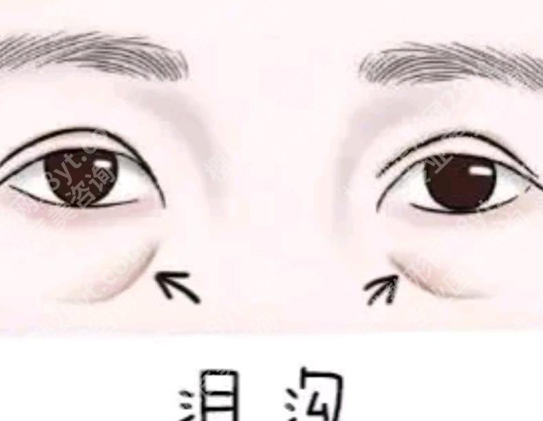 泪沟填充后淤青要多久才能恢复？填充要花多少钱？价格如何