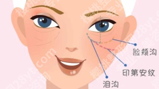 填泪沟用胶原蛋白多少钱？术后效果可以维持多久？