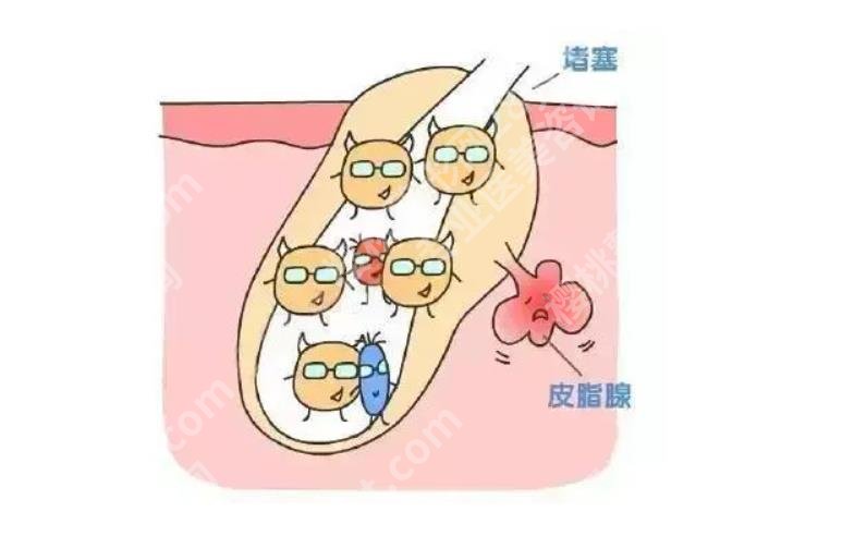 下巴长痘痘是什么原因？3个有效的解决方法揭秘