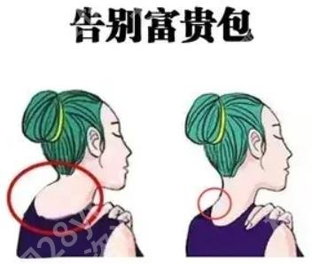 富贵包怎么消除有效？文末有预防富贵包的方法！