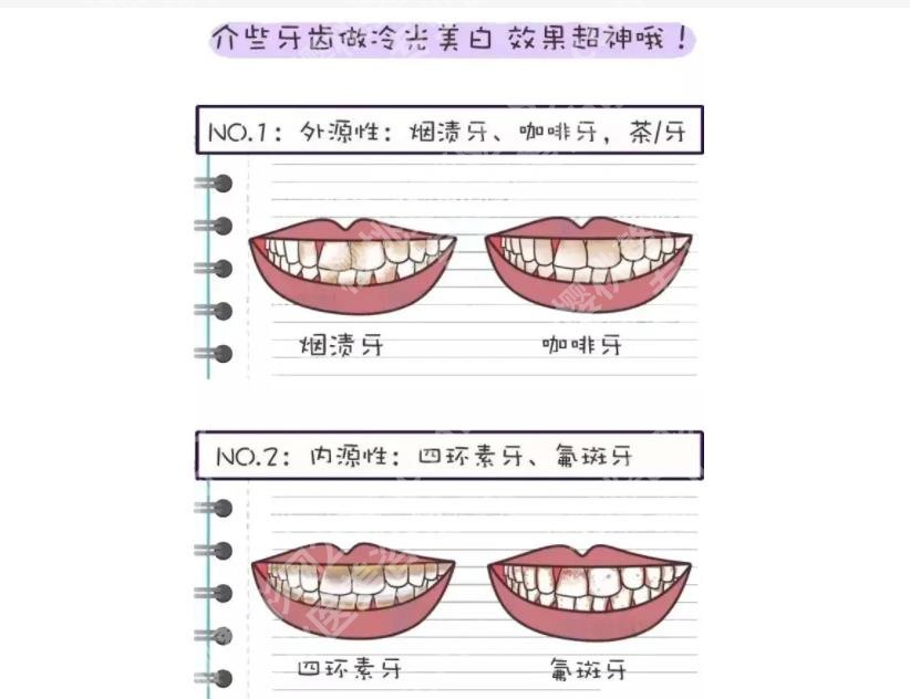 洗牙齿有什么好处和坏处有哪些？注意事项、价格表分享