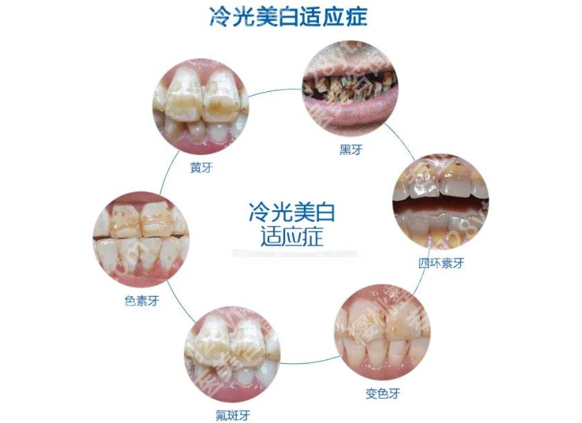 洗牙齿有什么好处和坏处有哪些？注意事项、价格表分享