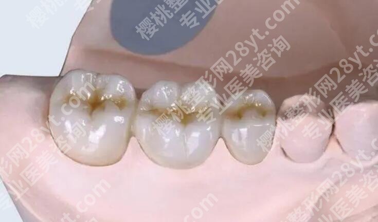 补牙后注意事项有哪些？补牙材料、收费价格表明细一览