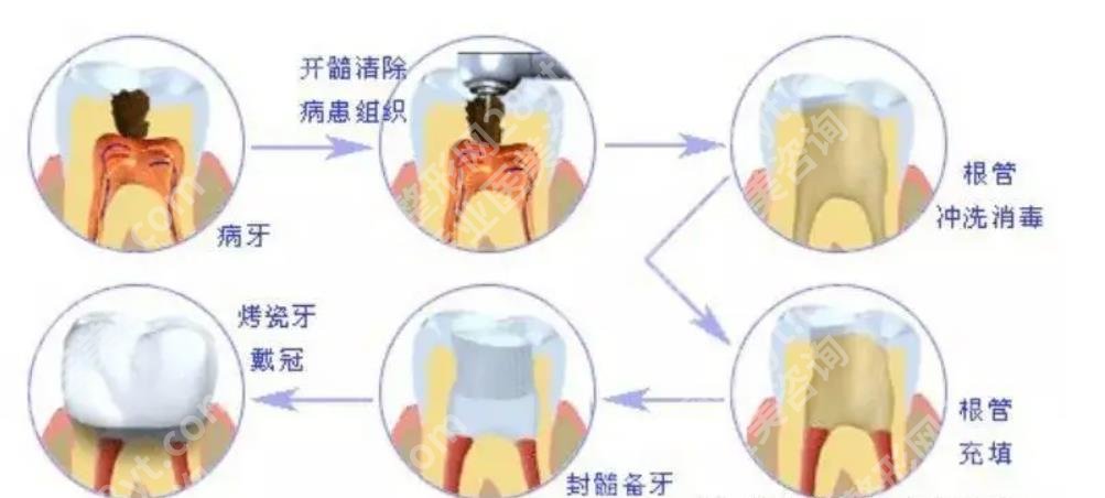 补牙后注意事项有哪些？补牙材料、收费价格表明细一览