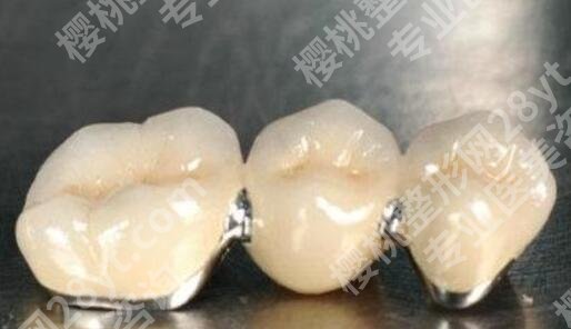 烤瓷牙的价格贵不贵？是多少？影响费用变动的因素有哪些？