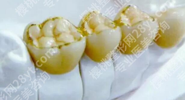 烤瓷牙的价格贵不贵？是多少？影响费用变动的因素有哪些？