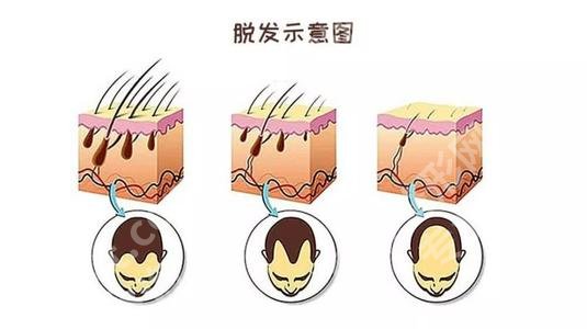 头发油腻又脱发怎么办？是什么原因？