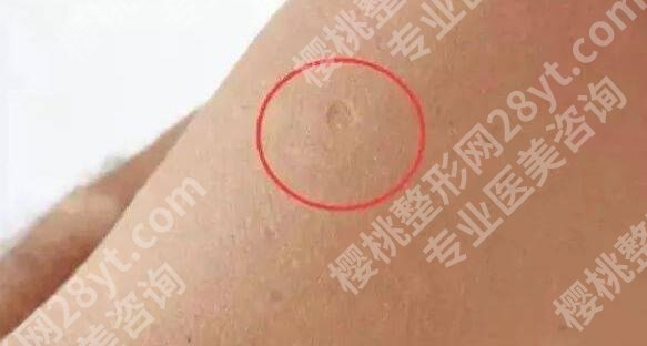 胳膊上的疤是什么疫苗留下的？冷知识分享！