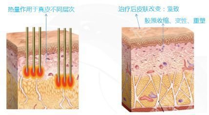 热玛吉一次多少钱？价格费用明细、功效作用揭晓！