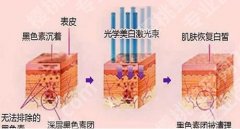 光子嫩肤后注意事项有哪些？几天恢复较好的状态？