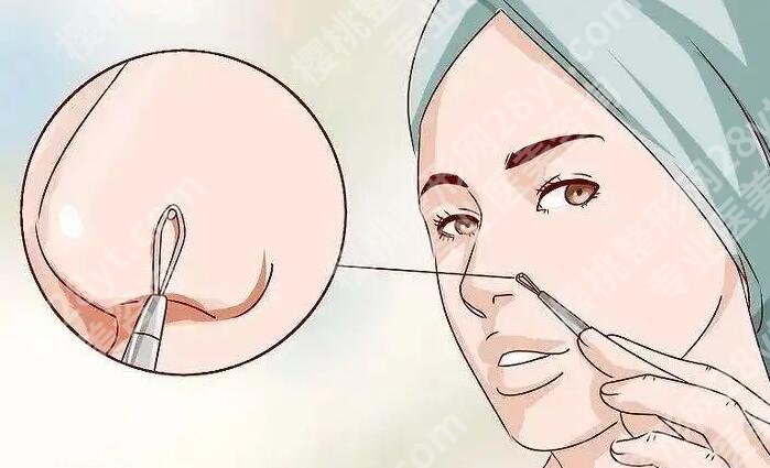 鼻子上有黑头怎么办？有什么好的方法可以去掉吗？科普知识汇总