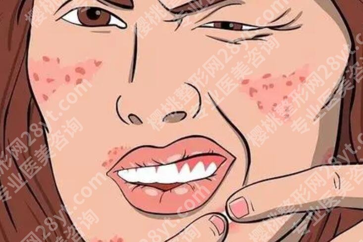 嘴角长痘痘是什么原因？有什么方法可以祛痘呢？