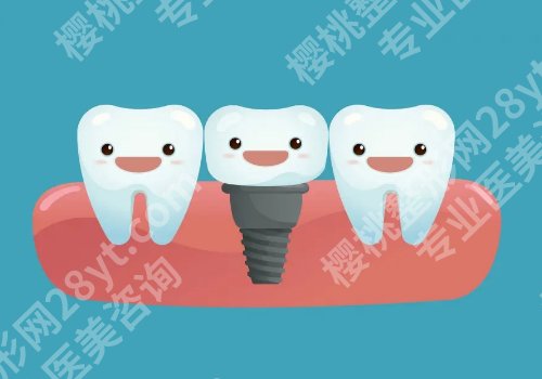 种植牙要多少钱？优势有哪些？需要注意什么？