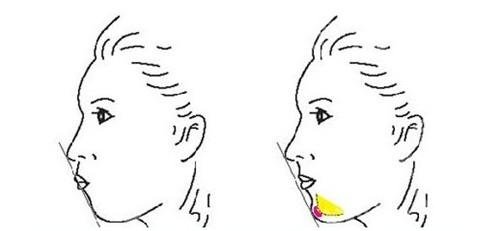 假体垫下巴可以管一辈子吗？价格贵吗？多久恢复？