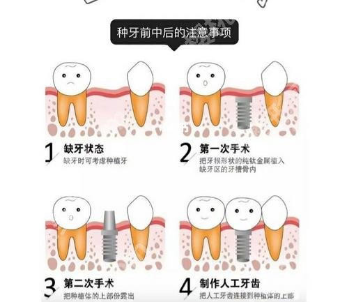 种植牙多少钱一颗2023价格表_种植牙优势、恢复时间盘点