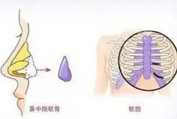 肋软骨隆鼻多少钱？价格费用明细、注意事项分析！