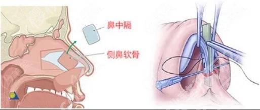 肋软骨隆鼻多少钱？价格费用明细、注意事项分析！