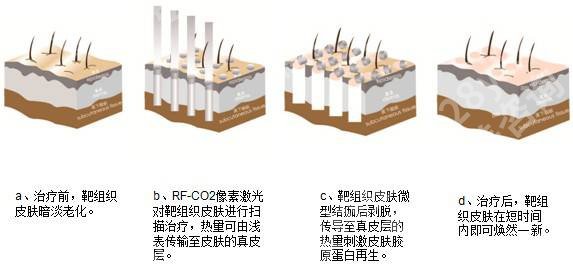 像素射频价格是多少？适应症、原理有哪些？