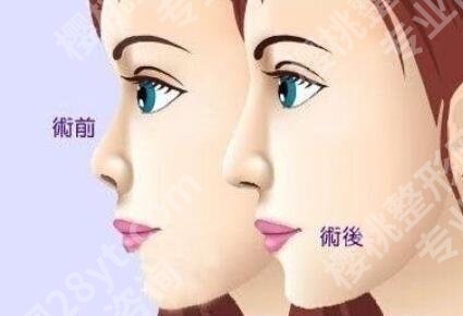 黄大勇做鼻子怎么样？案例反馈：容貌升高一个级别！