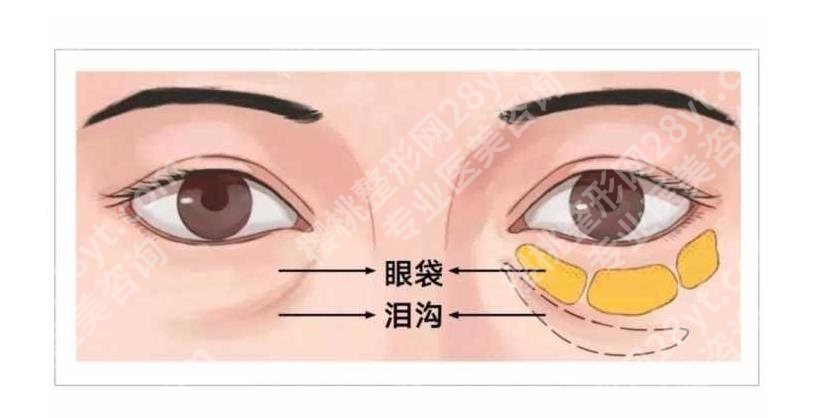 内切眼袋填充泪沟手术后遗症有哪些？恢复期、价格等汇总！