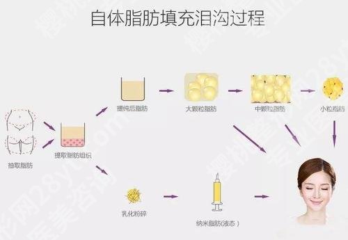 内切眼袋填充泪沟手术后遗症有哪些？恢复期、价格等汇总！