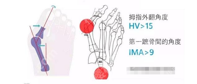 拇外翻咋治？保守调节、大脚骨手术介绍！