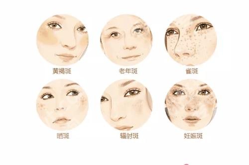 蓝宝石激光祛斑原理是什么？术后护理事项分享！