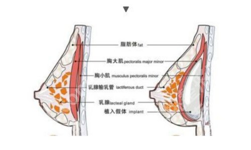 北京八大处胸部整形缩小手术多少钱？收费价目与医生名单