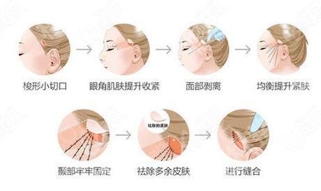 黄寅守做拉皮手术怎么样？北京加减美除皱专家实力测评！附案例解析！