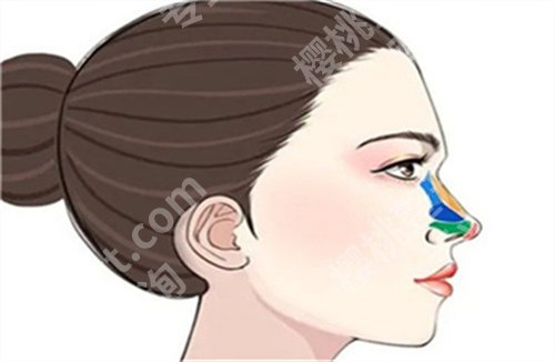 北京薛志强教授怎么样？隆鼻案例新鲜出炉了