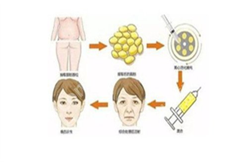 北京玉之光张红芳脂肪填充怎么样？医院+医生简介