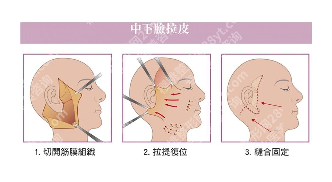 北京艺星医疗美容医院除皱价格，3100元-37000元不等！附除皱案例