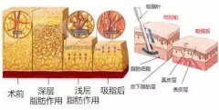 温州二医(温医二院)抽脂多少钱？腰腹1.2万元起\脸部1.4万元起\小腿1.1万元起