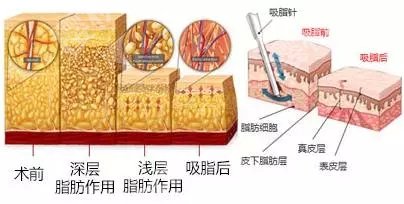温州二医(温医二院)抽脂多少钱？腰腹1.2万元起\脸部1.4万元起\小腿1.1万元起