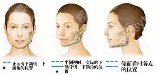 下颌角切除的价钱\手术费用参考范围在3.5万元左右！改脸型科普