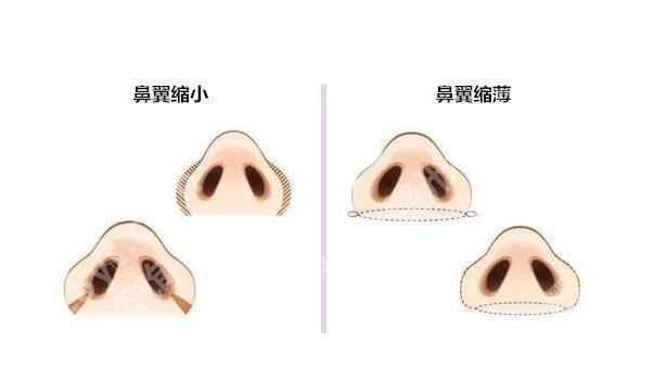 鼻头缩小手术要多少钱？费用大概是5千元到2万元不等！