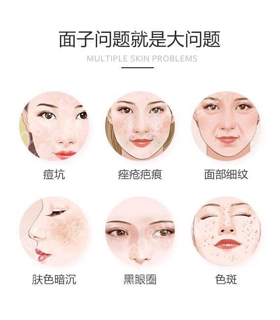激光去痘印要多少钱？激光去痘印后反弹吗？肌肤修复指南！
