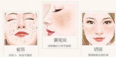 激光去除老年斑怎么样？会留疤吗？需要调节几次？